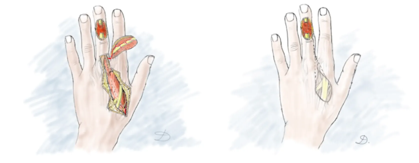 Pedicled Vascular Flap Transfer