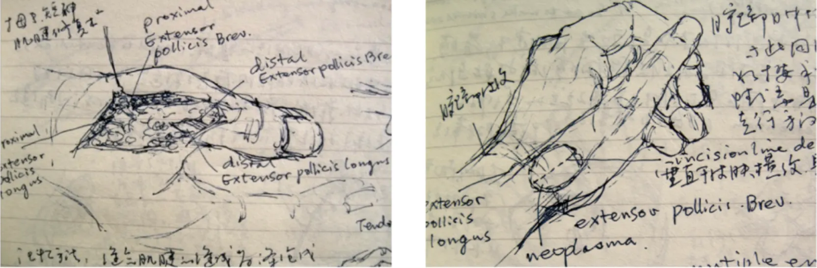 Tendon Repair Exposure